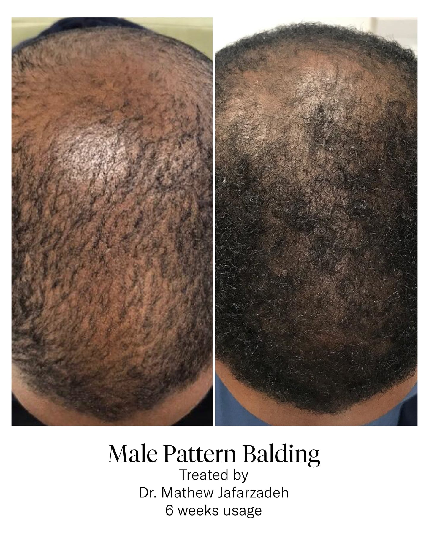 Advanced Hair System